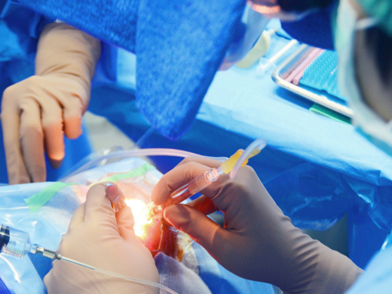 Cataract Surgery